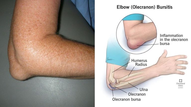 Are Pointy Elbows Normal